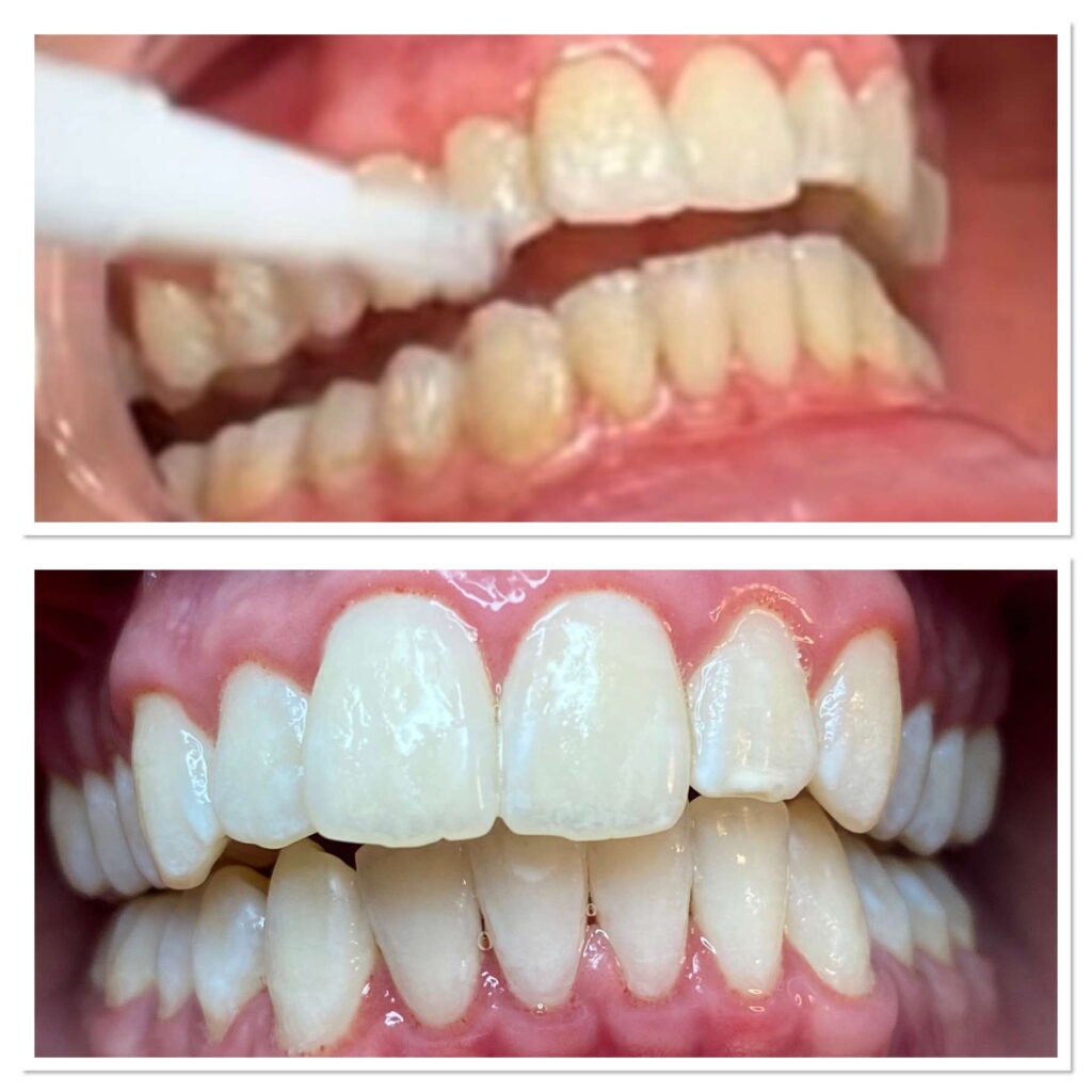 teeth-whitening10